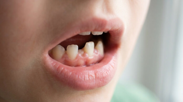 Bouche d'enfant montrant une dent de lait et une dent permanente émergente derrière. Illustration du phénomène des "dents de requin".